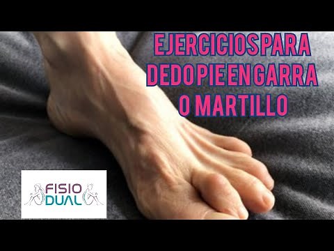 Ejercicios para DEDOS DEL PIE EN GARRA O MARTILLO