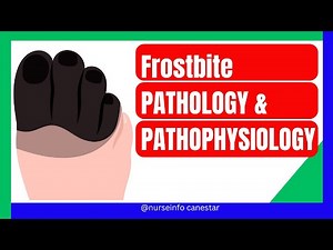Frostbite PATHOLOGY AND PATHOPHYSIOLOGY - Explained 📌