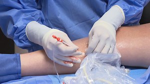 Vein therapy may benefit patients with vascular insufficiency