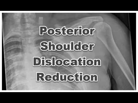 The Kona Posterior Shoulder Dislocation Reduction Technique