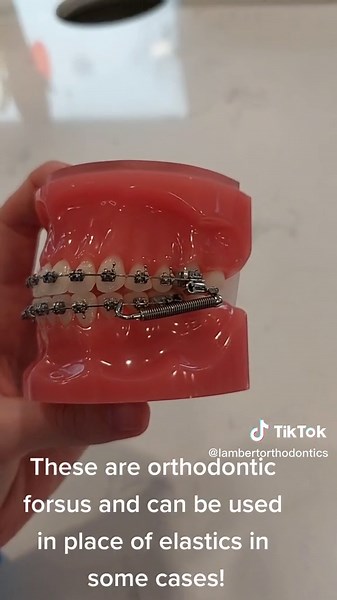 Orthodontic Elastics: Class 2, 3 & More Explained