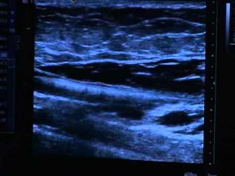 VNUS Closure Procedure - Patient Education Video