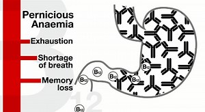 175K views · 689 reactions | It leaves you facing exhaustion, shortage of breath, and even memory loss. Thousands of people across the south could be suffering from a vitamin B12 deficiency. Patients have told BBC South Today that GP's prescription guidelines mean they do not get enough of the supplements, leaving many to resort to injecting themselves with unlicensed goods | BBC Hampshire & Isle of Wight | Facebook