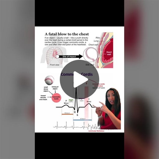 Commotio Cordis: Understanding Cardiac Arrest in Sports