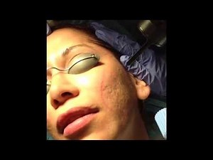 Acne Scarring Treated with Mixto CO2 laser- Dr. David Rahimi- Forever Young, Inc.