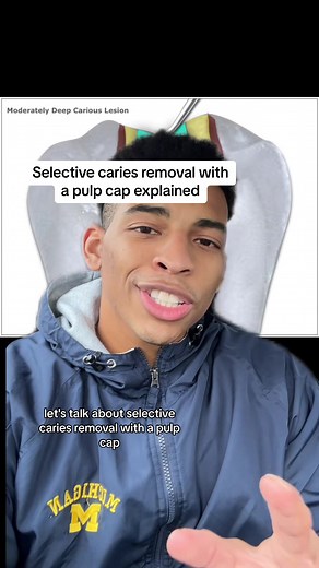 selective caries removal pulp cap explained #dentist #doctorsoftiktok #rootcanal #dentistry #dentalhygienist #learnontiktok #greenscreen