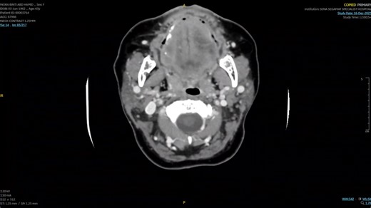Today’s procedure provided a compelling demonstration of meticulous anatomical dissection along avascular tissue planes. The patient presented with chronic cough and neck discomfort, initially suggestive of a prominent right-sided goiter. Further evaluation revealed a large posterior retrosternal extension descending to the level of the aortic arch (classified as BII), which displaced the thyroid cartilage and trachea to the left, causing significant compression. The total thyroidectomy reinforc