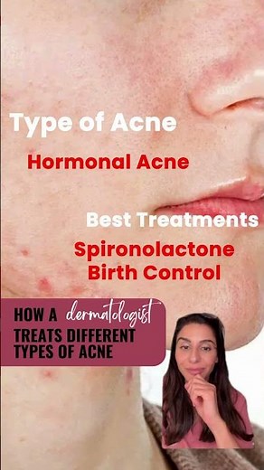 Understanding different types of acne and how to treat them!