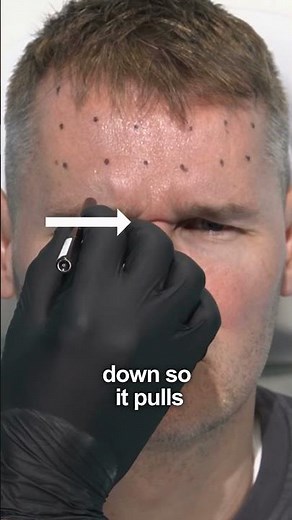 Procerus muscle overview