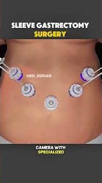 How Sleeve Gastrectomy Surgery Is Done (3D Animation #3danimation #medicaleducation #healthcare #fyp