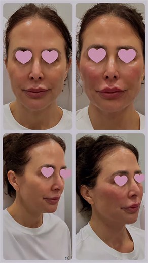 Bare Skin MD on Instagram: "✨ Naturally Regenerative. Undeniably Refreshed. ✨ This transformation was achieved using 12 syringes of Derma PRP, strategically placed across the face and neck to restore soft volume, enhance lift, and tighten the skin—using the body’s own regenerative power. Derma PRP is created from your own plasma, processed into a smooth gel that integrates seamlessly with your tissue while stimulating collagen and long-term rejuvenation. The result isn’t dramatic. It’s refined. 