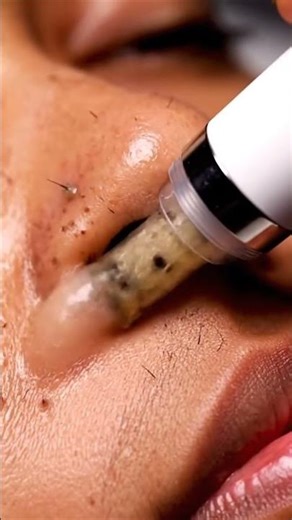 Back Blackhead Removal 🔥 Heavy Extraction ASMR