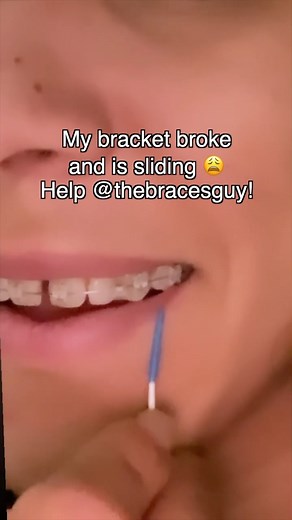 The Braces Guy on Instagram: "Broken bracket sliding on wire? 😬 Here’s what to do… #braces #orthodontist #braceface #braceslife #adultbraces"