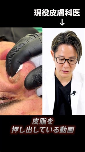 Is this method of removing blackheads from the nose safe? A practicing dermatologist explains #sh...