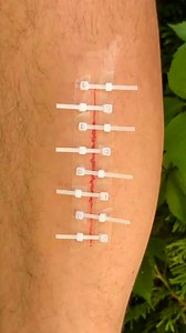 Emergency wound closure trick | Pixel Pop