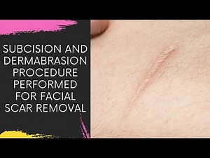 SUBCISION AND DERMABRASION PROCEDURE PERFORMED FOR FACIAL SCAR REMOVAL IN NAVI MUMBAI