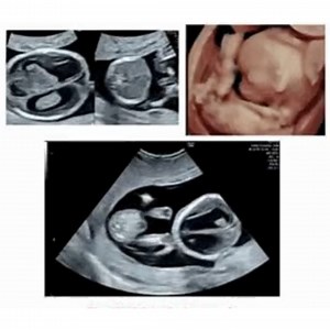 Ahead of our hybrid course, The ISUOG India Symposium: making the uncommon common, your chair Dr Meetan Preet has come up with this week's #ISUOGEducation quiz question! 🤩 Of this first trimester fetus with extremely low PAPPA and bHCG, this finding is most suggestive of: A. Trisomy 21 B. Monosomy X C. Triploidy D. Noonan’s syndrome Comment your answer below and come back next Friday to see if you were correct. If you liked this question, why not sign up to the ISUOG India Symposium: making the