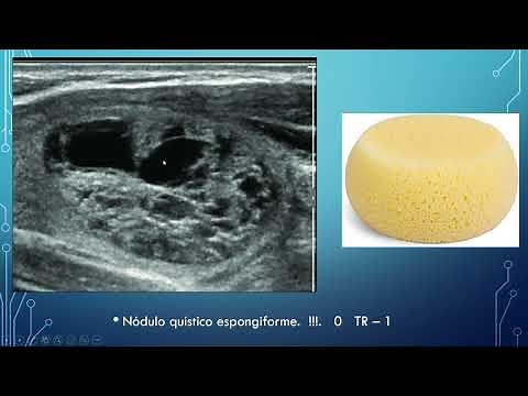 ECOGRAFIA DE TIROIDES, EVALUACION DE NODULOS, APLICACION TI RADS