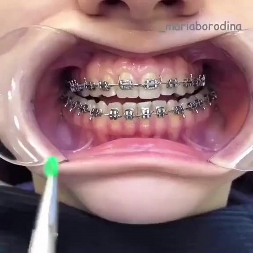 CrossBite Elastics ! #onthisday