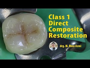 Class I Direct Composite Restoration • Video • MEDtube.net