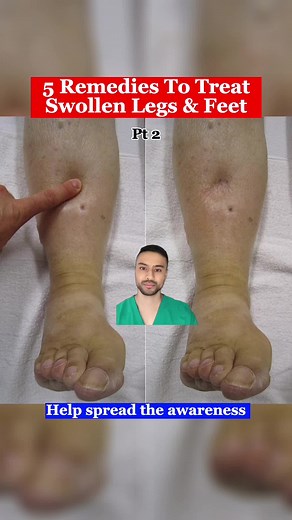 5 ways to get rid of swollen feet and legs #fyp #medical #feet #legs #swollenfeet #thegoodfootdoctor