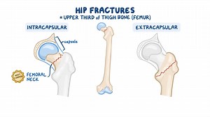 Video: Hip fractures: Nursing - Video Explanation! | Osmosis | Osmosis