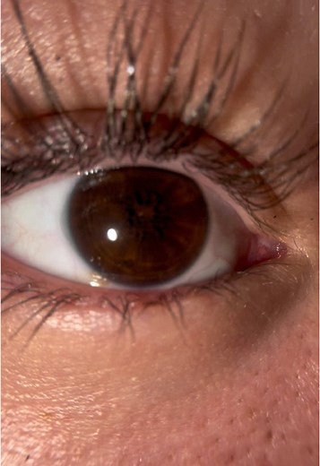 Understanding Persistent Pupillary Membrane in Eyes