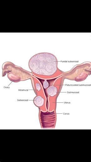 Fibroids are noncancerous growths made of muscle and fibrous tissue that develop in or around the uterus. They’re also called uterine fibroids or leiomyomas. They are very common, especially in women in their 30s and 40s, and many people never know they have them because they may not always cause symptoms.