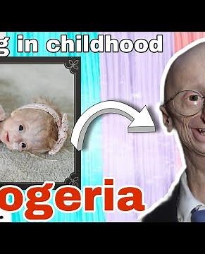 Neonatal Progeria | Aging in young age | aka Hutchinson-Gilford syndrome