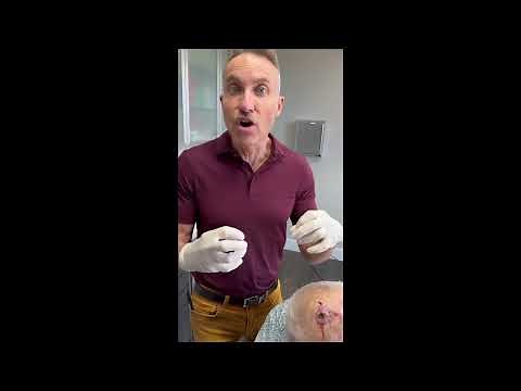 Keratoacanthoma Treatment Video: ke