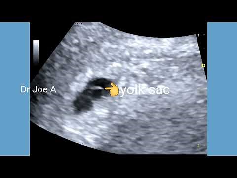 Early intrauterine pregnancy confirmation by yolk sac on transvaginal scan- ultrasound video
