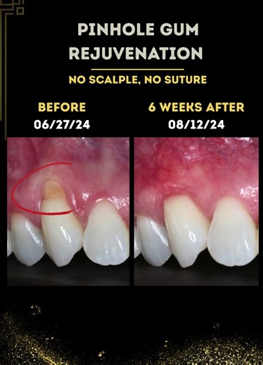 Say Goodbye To Gum Recession In 1 Session! #gumrecession #pinholesurgicaltechnique