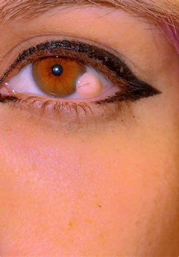 It's a dermoid cyst, doesn't hurt me, i can't remove it because it's a full circle so half outside of my eye and half in, it feels like jello, doesn't affect my vision. 🖤 #dermoidcyst #closeup #specialeyes #hazeleyes #laseine #Inverted