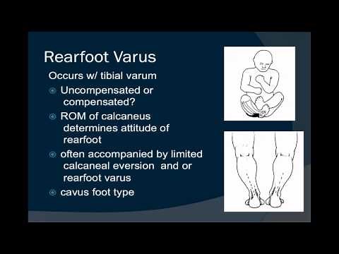 rearfoot varus