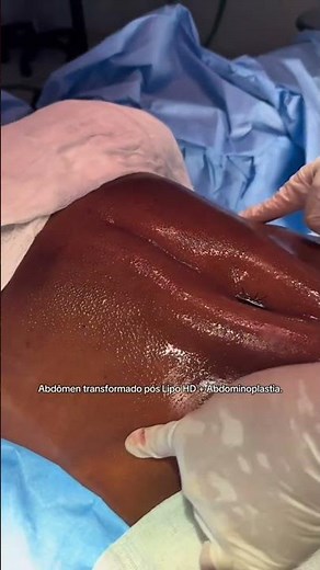 BEFORE AND AFTER OF A POST-PREGNANCY ABDOMEN | Dr. Ícaro Samuel #tummytuck #pregnancy