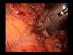 Triple-Track Technique For Laparosocpic Total Procto Colectomy • Video • MEDtube.net
