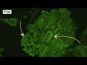 Fibrillary and Diabetes collision case | Collidescope episode 8