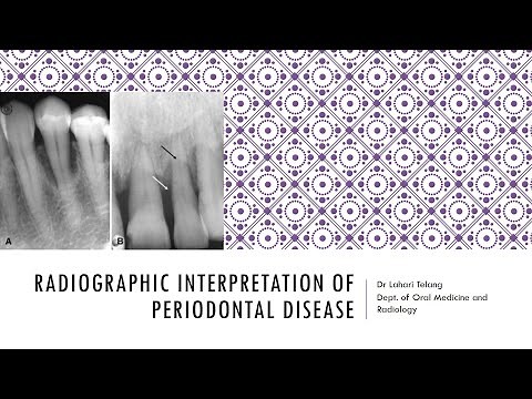 Radiographic Interpretation of Periodontal disease