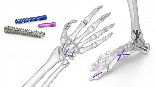 Acutrak 2 Headless Compression Screw System