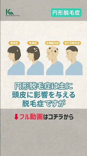 【100人に1～2人の割合で発症】円形脱毛症の原因と治療について皮膚科の専門医が徹底解説 #shorts