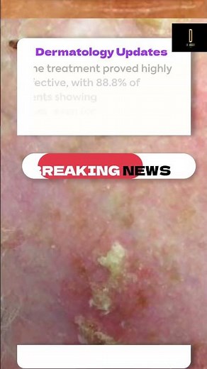 Tirbanibulin: FDA-Approved Breakthrough for Actinic Keratosis Treatment