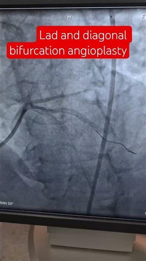 lad and diagonal bifurcation angioplasty.