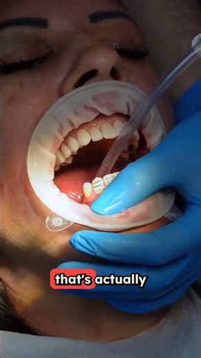 Gum Pockets Deeper Than 3mm Could Save Your Life (What Your Dentist Isn't Telling You)