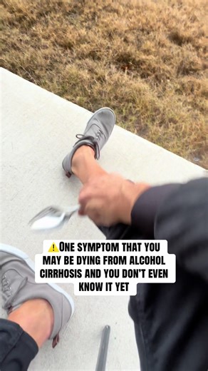 Alcohol cirrhosis symptom edema in the lower legs | edema lower leg