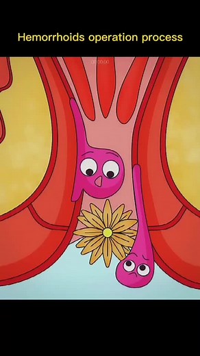 #hemorrhoids #operation #process #foryou #health #fypシ
