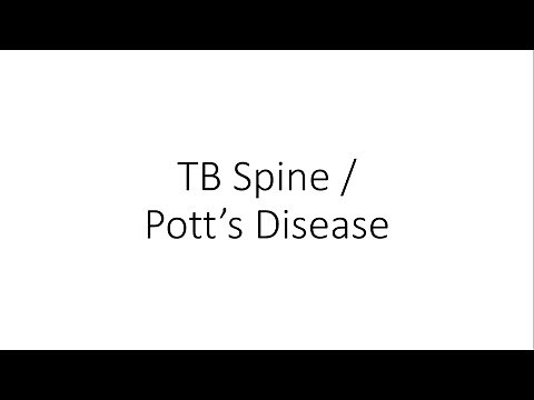 Tuberculosis of Spine / Pott's Disease - Orthopedics