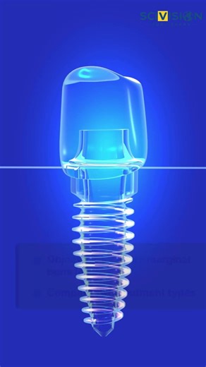 Screw-Retained Crowns & Bone Loss | Short Implant Research Explained | SciVision Publishers