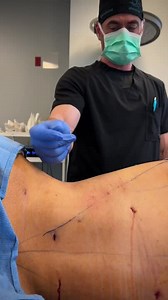 Rib Remodel Surgery: The Viral Body Contouring Secret To A SNATCHED Waist