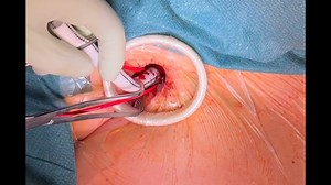 Impella 5.5 insertion: step by step