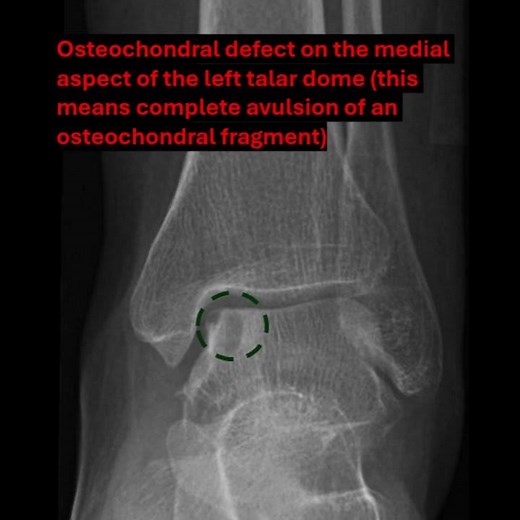 osteochondritis dissecans of the talar dome
